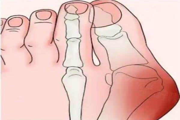 蘇敬達(dá)拇外翻排第幾名