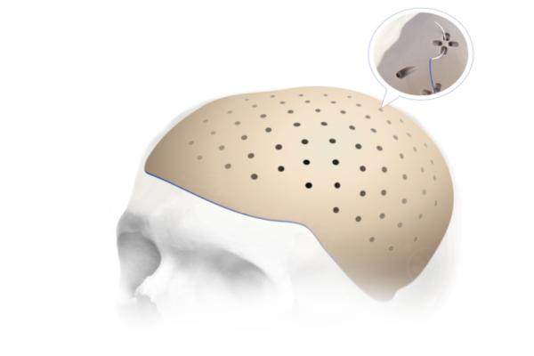 下頜角填充peek材料會(huì)不會(huì)有后遺癥