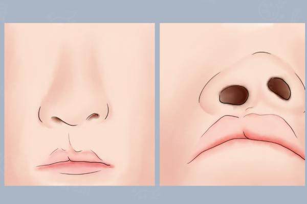 潘柏林醫(yī)生唇部手術(shù)實(shí)例