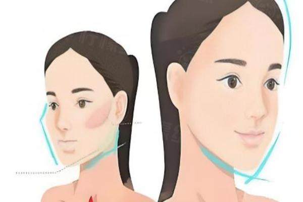 黃大勇磨骨多少錢