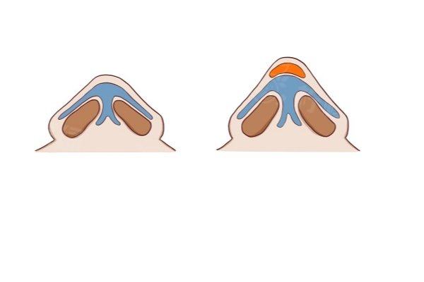 成都陳倩隆鼻<span style=