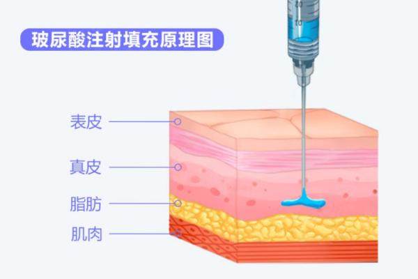 玻尿酸男性增大注射能保持幾年？1~2年，選對(duì)品牌多保持1年！3