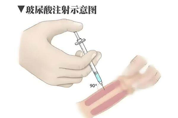 玻尿酸男性增大注射能保持幾年？1~2年，選對(duì)品牌多保持1年！