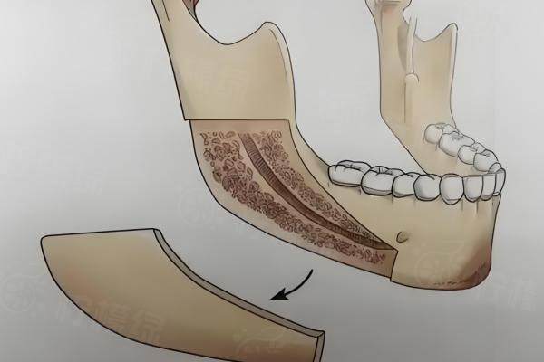 正頜手術(shù)截骨類型和術(shù)式區(qū)別