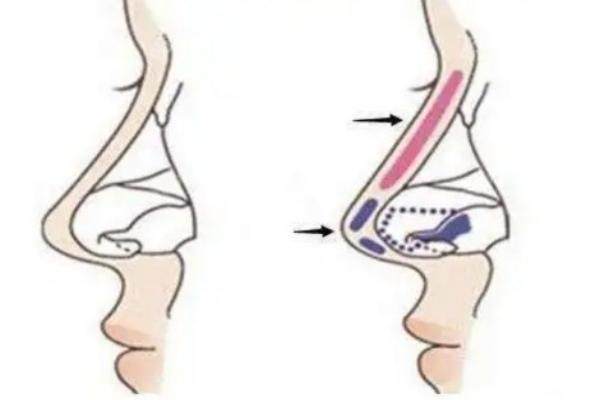 蘇州美萊做隆鼻怎么樣