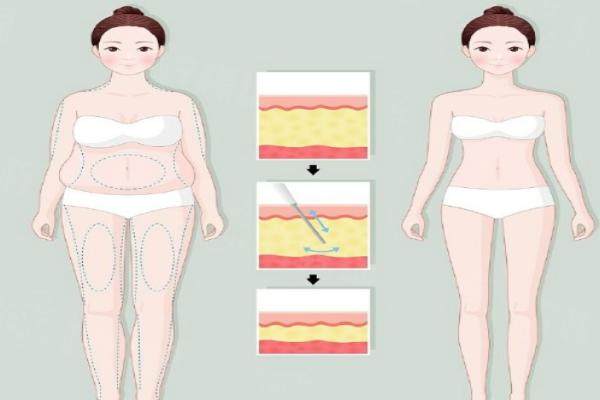 郭同榮醫(yī)生做吸脂多少錢