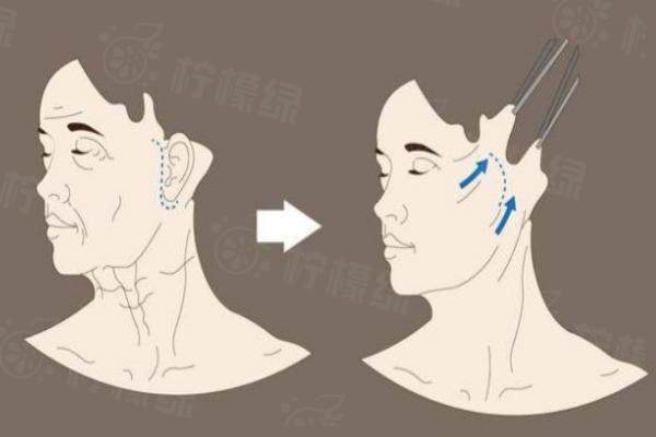 筋膜提升價(jià)格一般多少