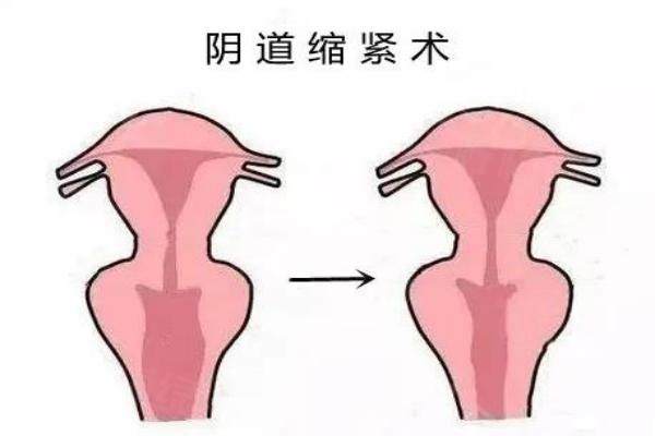 3d生物束縛帶緊縮效 果能維持多久？5年還是10年？這樣養(yǎng)護才能持久！3