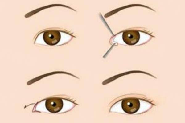 提眉手術(shù)多久能<span style=