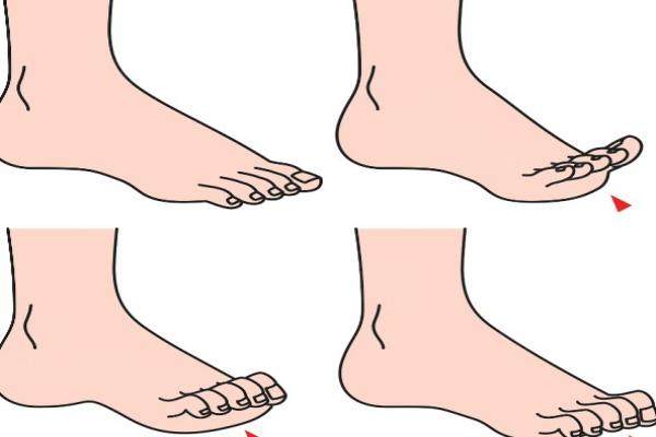 北京馬桂文醫(yī)生大腳骨矯正價格是多少