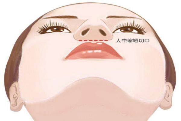 范開(kāi)防醫(yī)生人中手術(shù)怎么樣？隱藏切口術(shù)式，無(wú) 痕縮短真香，2萬(wàn)起價(jià)！2