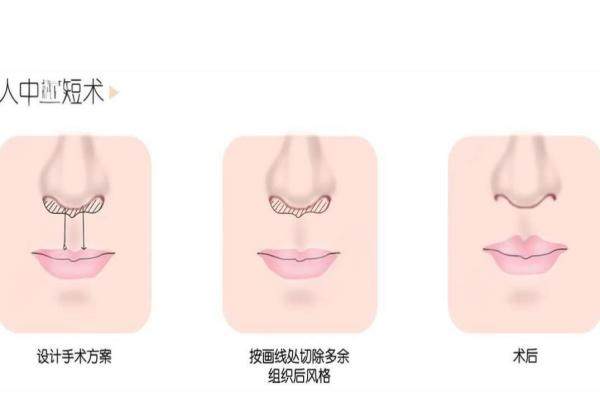 范開(kāi)防醫(yī)生人中手術(shù)怎么樣？隱藏切口術(shù)式，無(wú) 痕縮短真香，2萬(wàn)起價(jià)！3