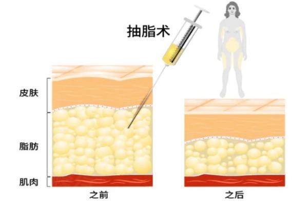 再希斯黃金微針和半島區(qū)別
